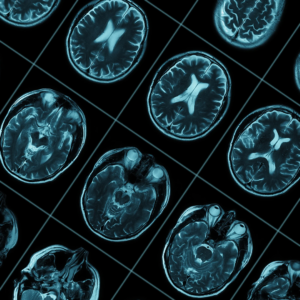 Managing the Cost of Alzheimer’s Care Through Early Disease Detection